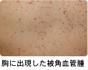 胸に出現した被角血管腫