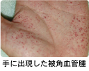 手に出現した被角血管腫